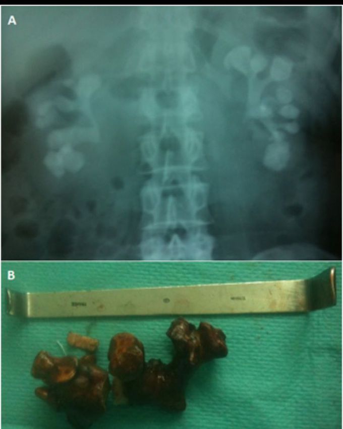 Staghorn stone