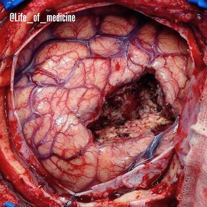 Amazing live surgery done to remove a large mass of a tumor in the brain! 😱😷
.
.
Brain tumors or intracranial neoplasm may originate from neural elements within the brain, or they may represent spread of distant cancers. Primary brain tumors arise from CNS tissue and account for roughly half of all cases of intracranial neoplasms. The remainder of brain neoplasms are caused by metastatic lesions.