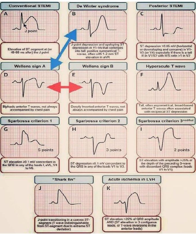 ECG Signs