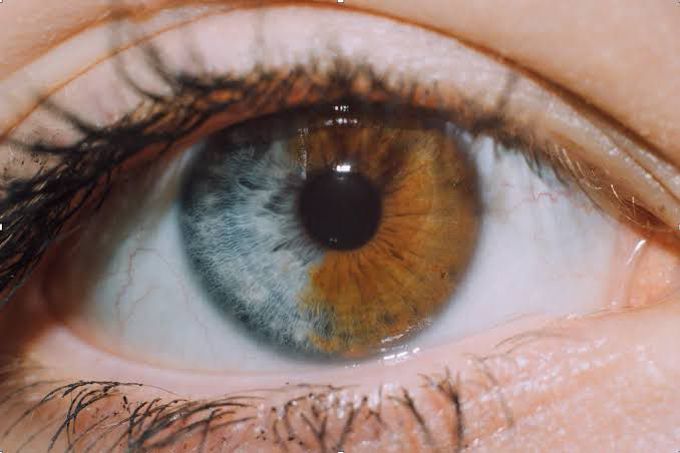 Heterochromia