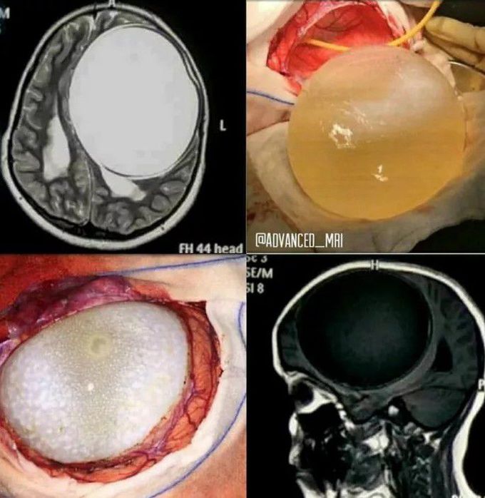 Neurosurgery