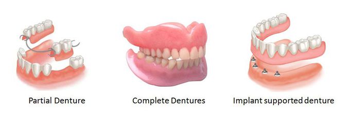 Fixed Vs Removable prosthesis