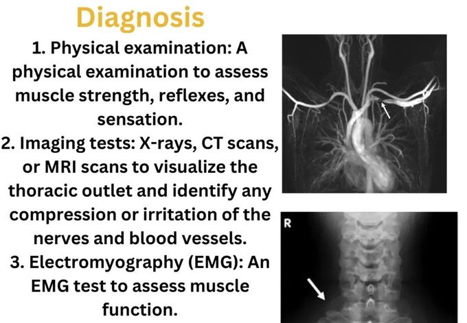 Thoracic Outlet Syndrome IV