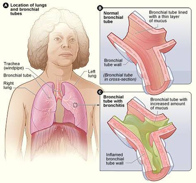 Bronchitis