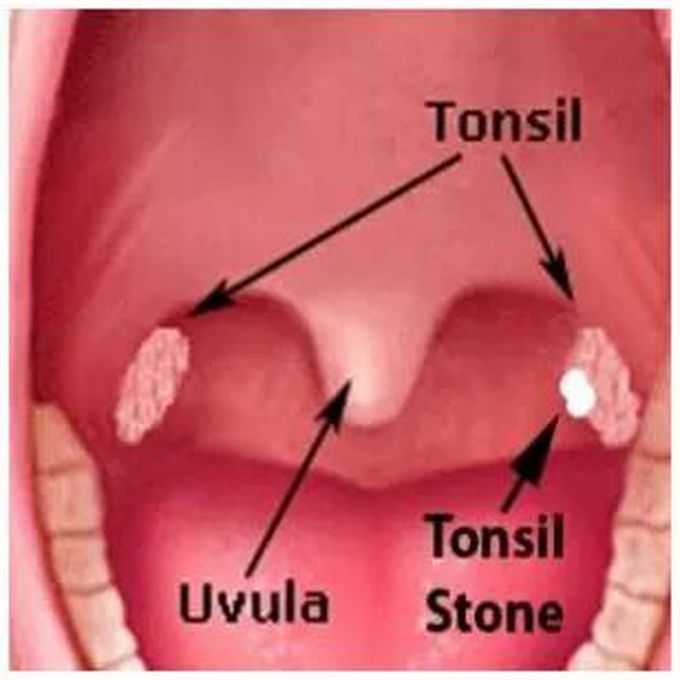 Камни на миндалинах в горле фото Tonsil Stones - MEDizzy