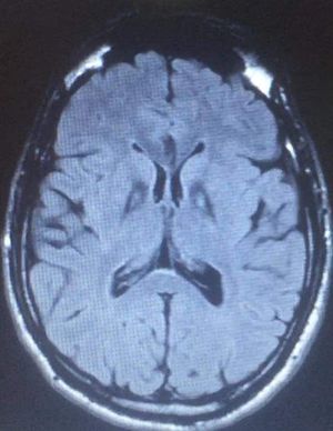 Neurodegeneration with brain iron accumulation - MEDizzy