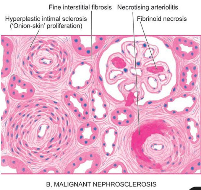 Microscopic changes in kidney in hypertension