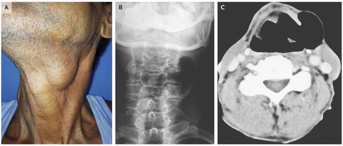 Laryngocele