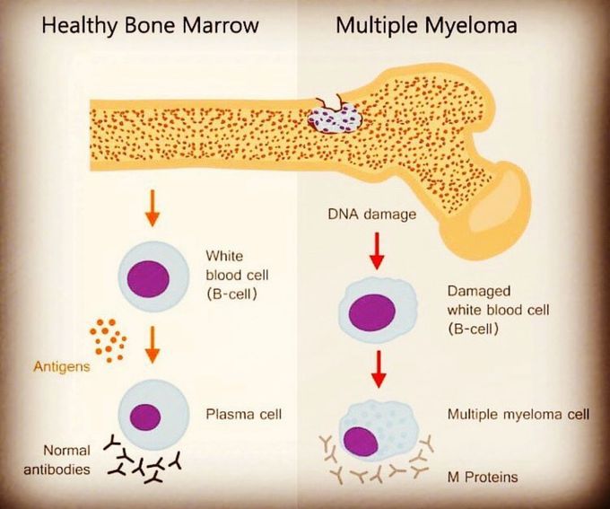 Health VS MM bone marrow