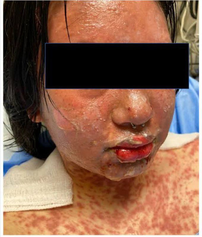 Treatment for Stevens-Johnson syndrome