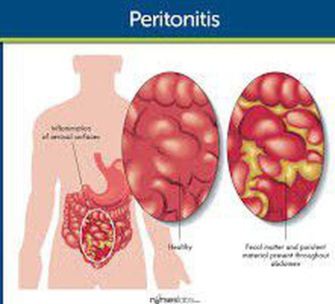 Causes of peritonitis