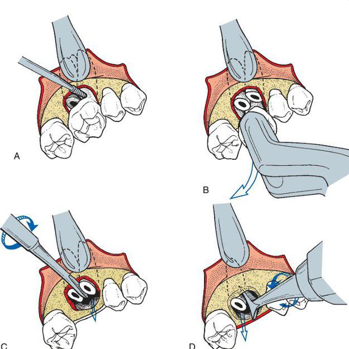 Removal of maxillary roots