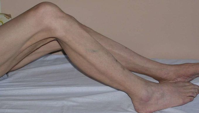 MUSCLE ATROPHY