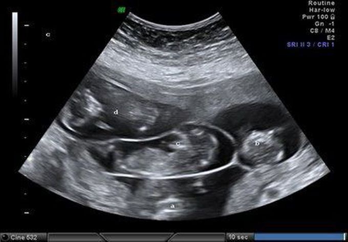 Just a ultrasound on quadruplets at 12 weeks