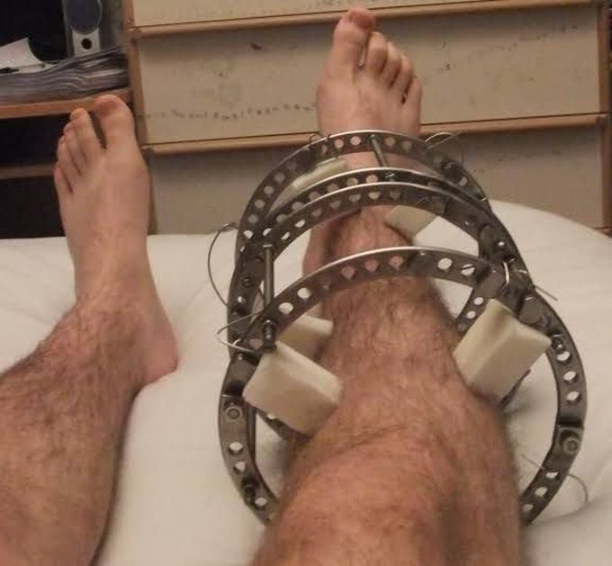 IRF(Ilizarov's ring fixation)