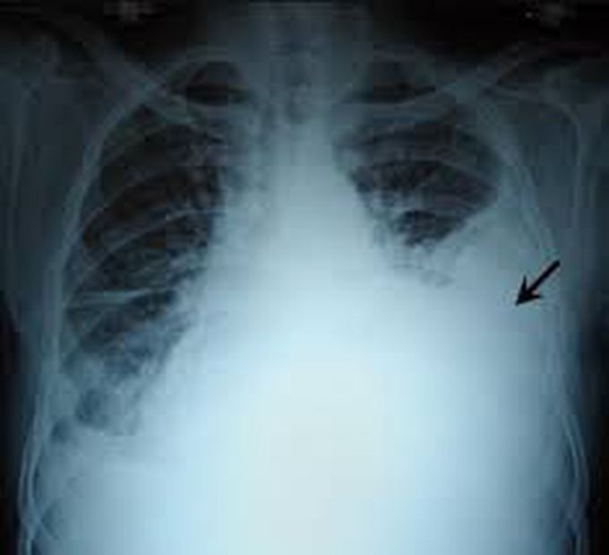 Hemothorax