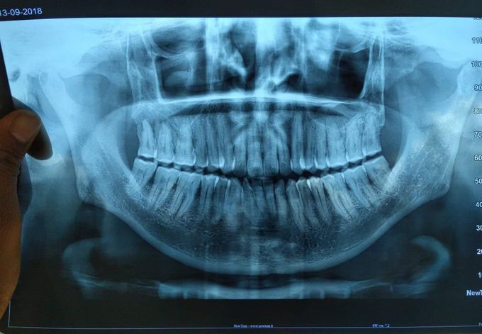 Dental OPG