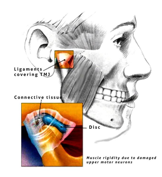 Symptoms of lock jaw