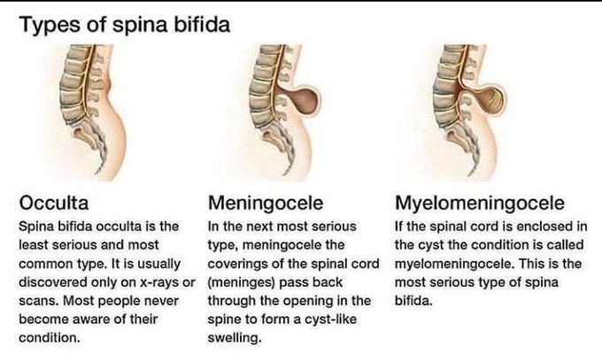 Types of spina bifida
