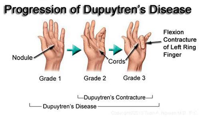 Grades of Dupuytren's contracture