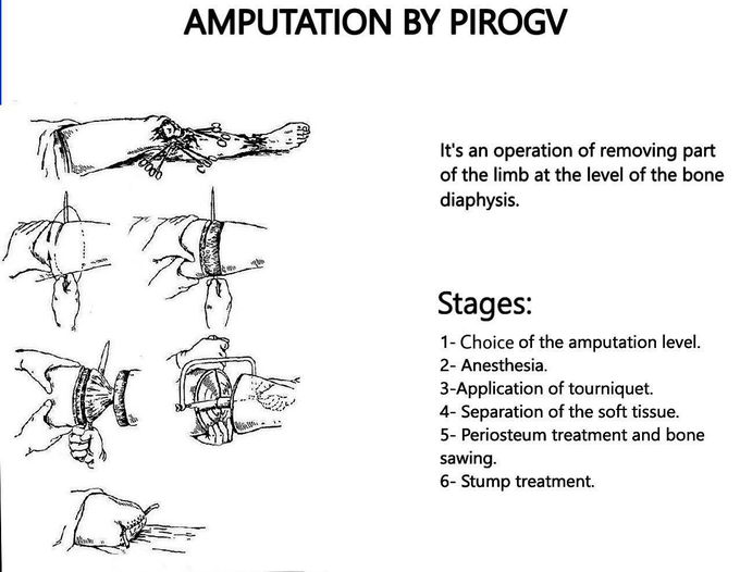 Limb Amputation