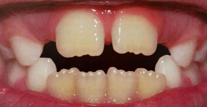 Primary vs permanent teeth morphology