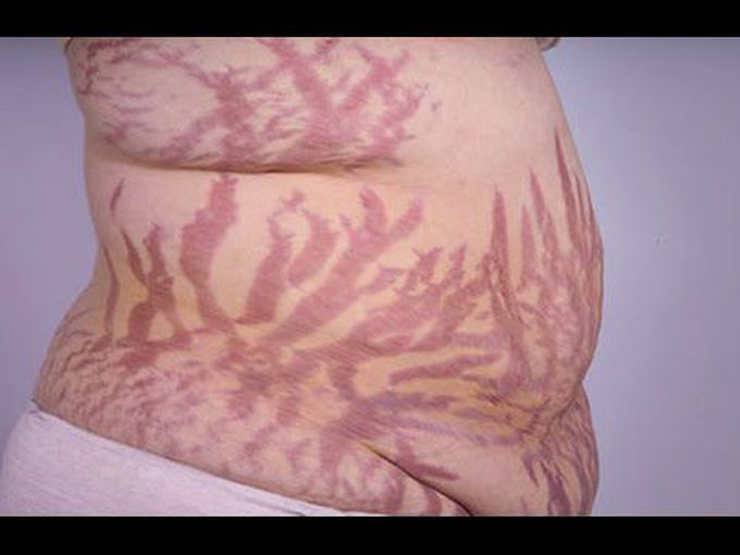 Cushing's syndrome