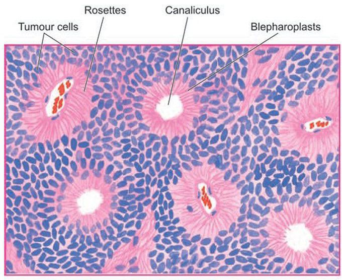 Ependymoma