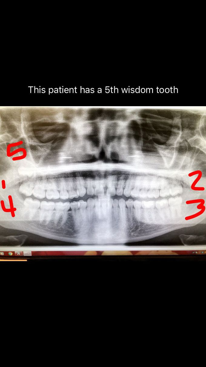 Supernumart teeth