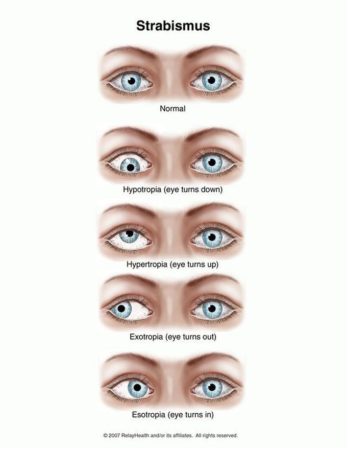 Strabismus types