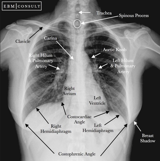 What we can see in a normal CXR