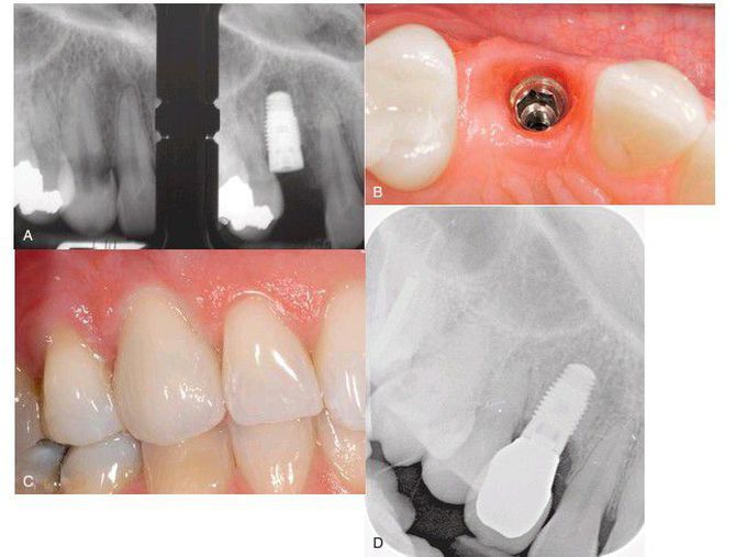 Single tooth replacement