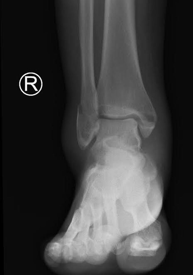 Bimalleolar fracture