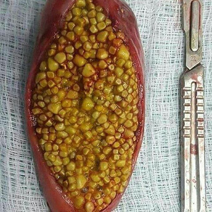Gall Stones in the Gall bladder of mid 40s man. 