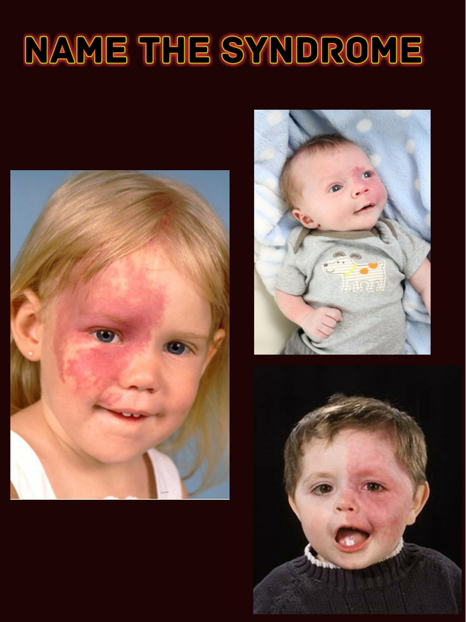 Name the syndrome