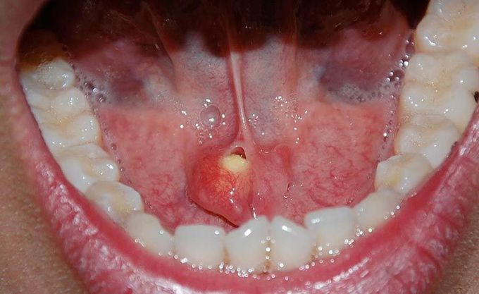 Salivary gland stone