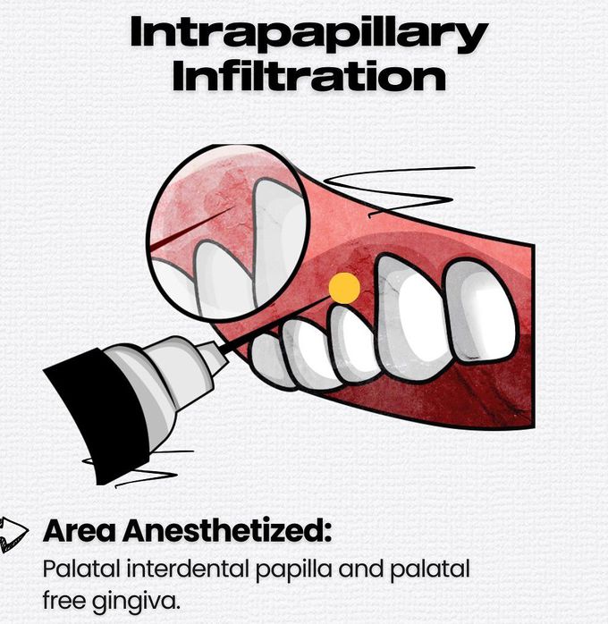 Maxillary Local Anesthesia VIII