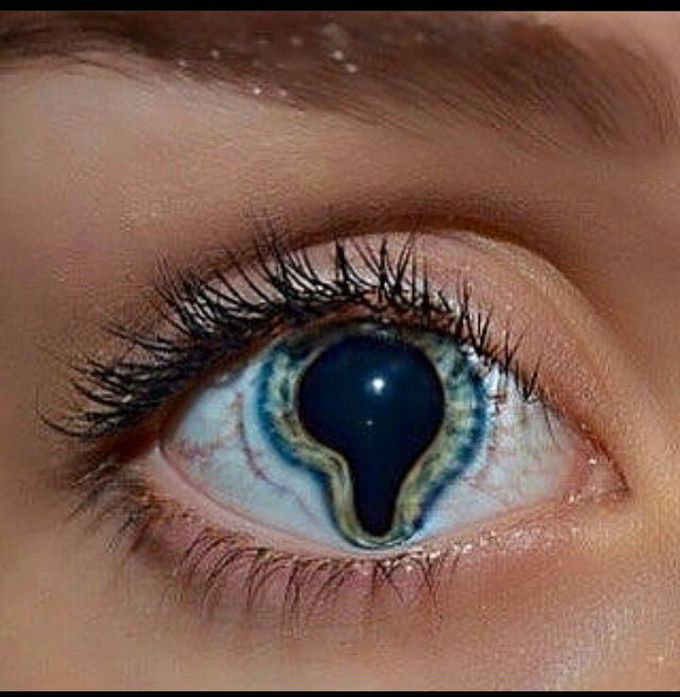 Coloboma