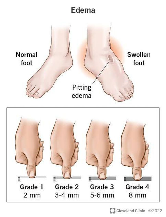 Edema