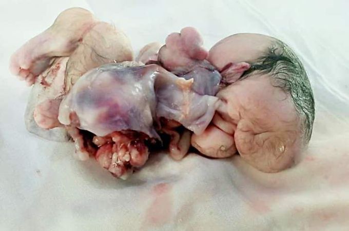 Fetus in Fetu.