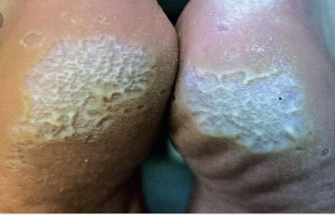 Pitted Keratolysis!!!