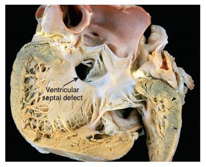 Ventricular septal defect