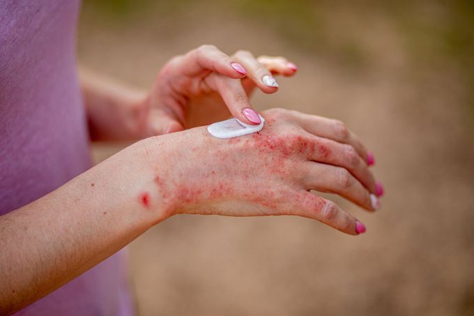 Treatment for Eczema