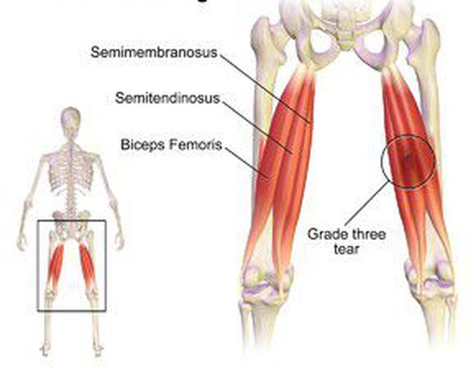 Muscle injury