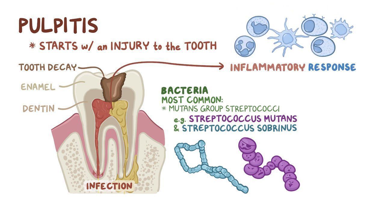 Pulpitis MEDizzy