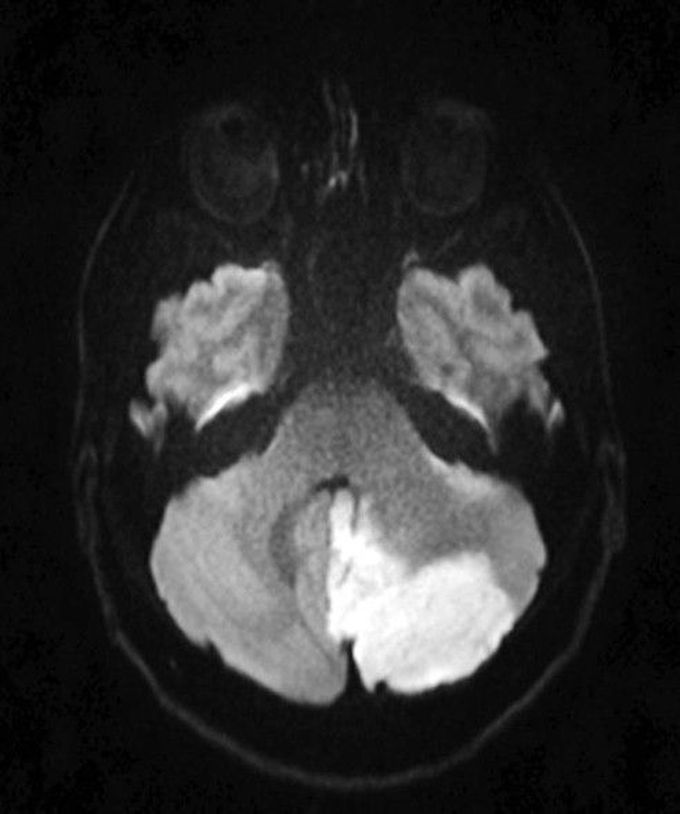 Cerebellar infarction
