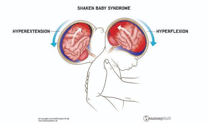 Causes of shaken baby syndrome
