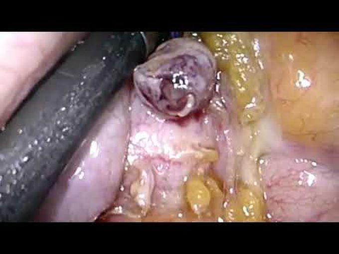 Parasite in the Appendix #medical #medstudent