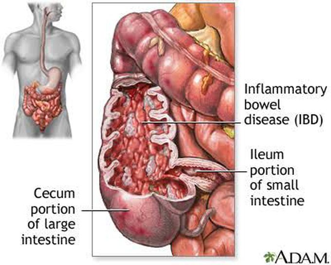 Signs and symptoms of crohn's disease