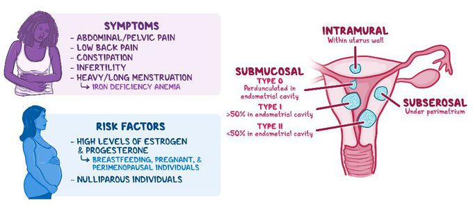 Symptoms of Uterine fibroids